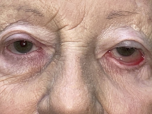 Ectropion, Entropion (Repair of Lower Lid Malposition)