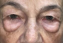 Upper/Lower Lid Blepharoplasty