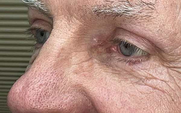 Eyelid Lift (Blepharoplasty/Ptosis Repair)