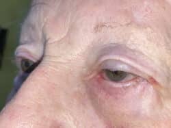 Ectropion, Entropion (Repair of Lower Lid Malposition)