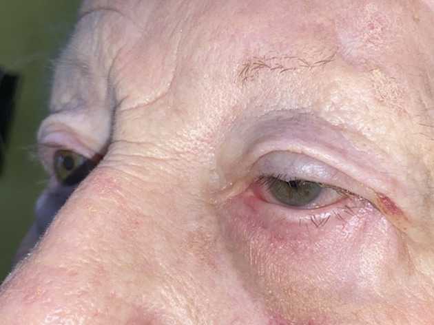 Ectropion, Entropion (Repair of Lower Lid Malposition)