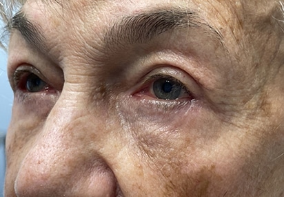 Upper/Lower Lid Blepharoplasty