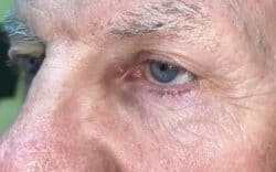Eyelid Lift (Blepharoplasty/Ptosis Repair)