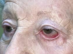 Ectropion, Entropion (Repair of Lower Lid Malposition)