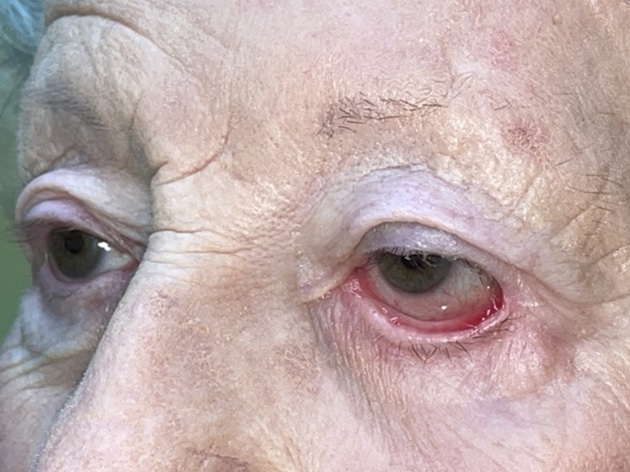 Ectropion, Entropion (Repair of Lower Lid Malposition)