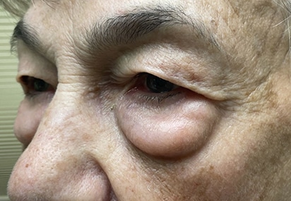 Upper/Lower Lid Blepharoplasty