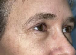Combination Surgeries (eyelid lift and other)