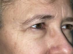 Combination Surgeries (eyelid lift and other)