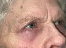 Combination Surgeries (eyelid lift and other)