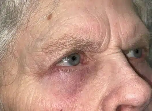 Combination Surgeries (eyelid lift and other)