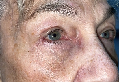Upper/Lower Lid Blepharoplasty
