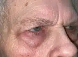 Combination Surgeries (eyelid lift and other)