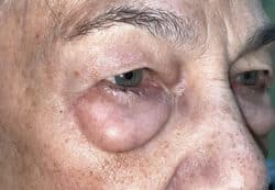 Upper/Lower Lid Blepharoplasty