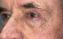 Eyelid Lift (Blepharoplasty/Ptosis Repair)