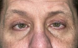 Eyelid Lift (Blepharoplasty/Ptosis Repair)