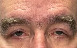 Eyelid Lift (Blepharoplasty/Ptosis Repair)