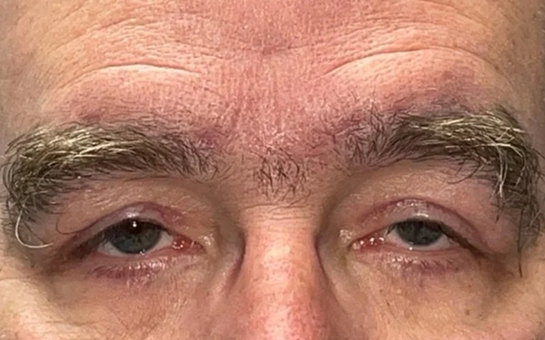 Eyelid Lift (Blepharoplasty/Ptosis Repair)