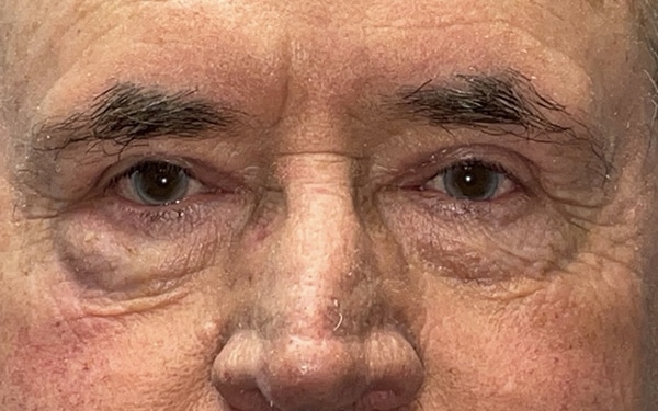 Eyelid Lift (Blepharoplasty/Ptosis Repair)