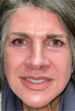 CO2 Laser Resurfacing (wrinkle/line reduction)