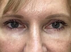 Combination Surgeries (eyelid lift and other)