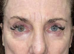 Combination Surgeries (eyelid lift and other)