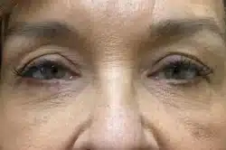 Lower Lid Blepharoplasty (lower eyelid eyelift)