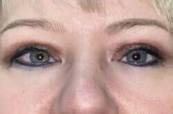 Upper Lid Blepharoplasty (upper eyelid lift)