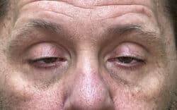 Eyelid Lift (Blepharoplasty/Ptosis Repair)