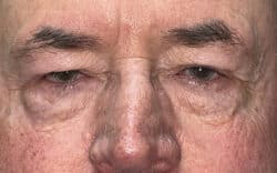 Eyelid Lift (Blepharoplasty/Ptosis Repair)