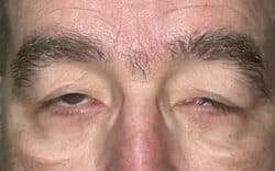 Eyelid Lift (Blepharoplasty/Ptosis Repair)