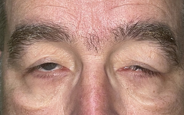 Eyelid Lift (Blepharoplasty/Ptosis Repair)