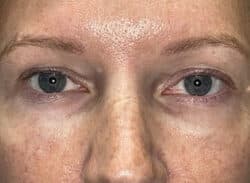 Combination Surgeries (eyelid lift and other)