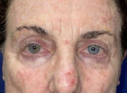 Combination Surgeries (eyelid lift and other)