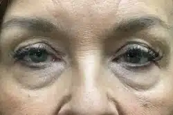 Lower Lid Blepharoplasty (lower eyelid eyelift)