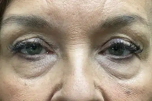 Lower Lid Blepharoplasty (lower eyelid eyelift)