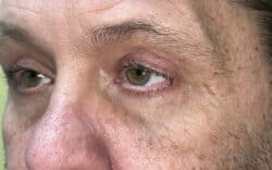 Eyelid Lift (Blepharoplasty/Ptosis Repair)