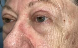 Eyelid Lift (Blepharoplasty/Ptosis Repair)
