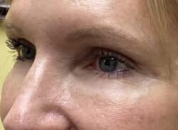 Combination Surgeries (eyelid lift and other)