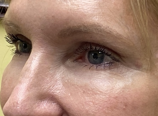 Combination Surgeries (eyelid lift and other)