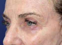 Combination Surgeries (eyelid lift and other)