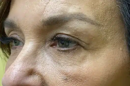 Lower Lid Blepharoplasty (lower eyelid eyelift)