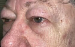 Eyelid Lift (Blepharoplasty/Ptosis Repair)