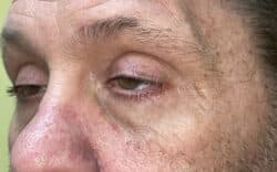 Eyelid Lift (Blepharoplasty/Ptosis Repair)