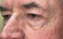 Eyelid Lift (Blepharoplasty/Ptosis Repair)