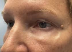Combination Surgeries (eyelid lift and other)
