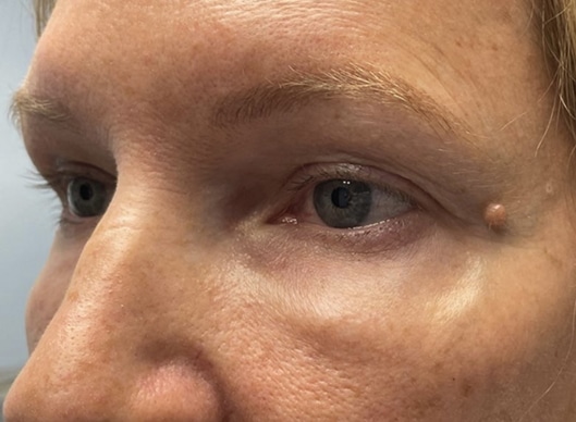 Combination Surgeries (eyelid lift and other)