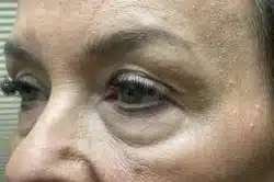 Lower Lid Blepharoplasty (lower eyelid eyelift)