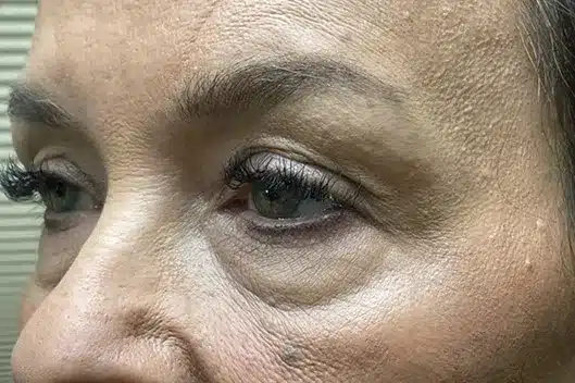 Lower Lid Blepharoplasty (lower eyelid eyelift)