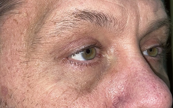 Eyelid Lift (Blepharoplasty/Ptosis Repair)