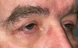 Eyelid Lift (Blepharoplasty/Ptosis Repair)